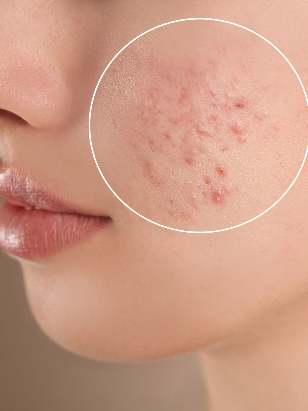 Acne