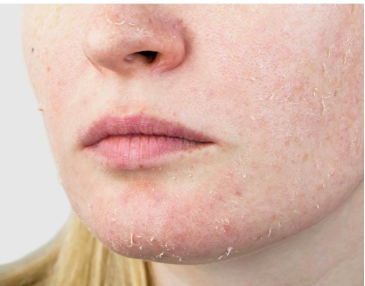Dry Skin
