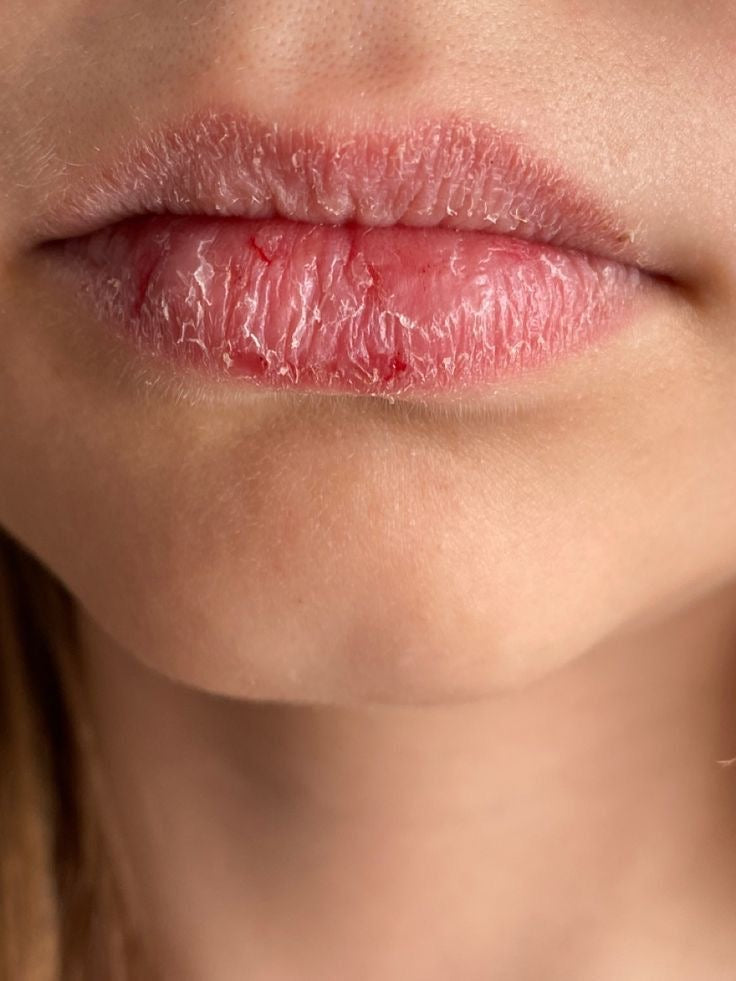 Dry Lips