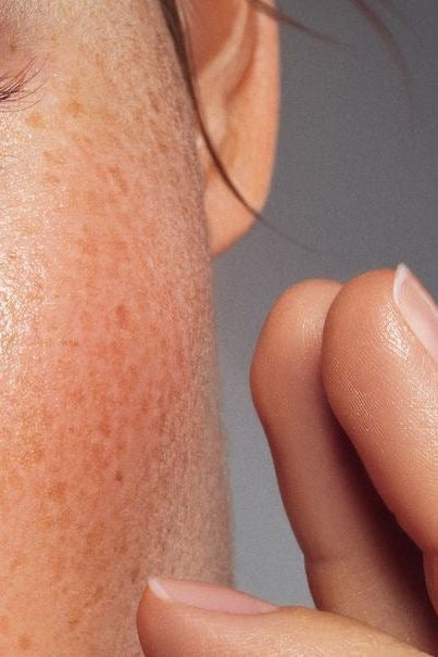 Irritated Skin