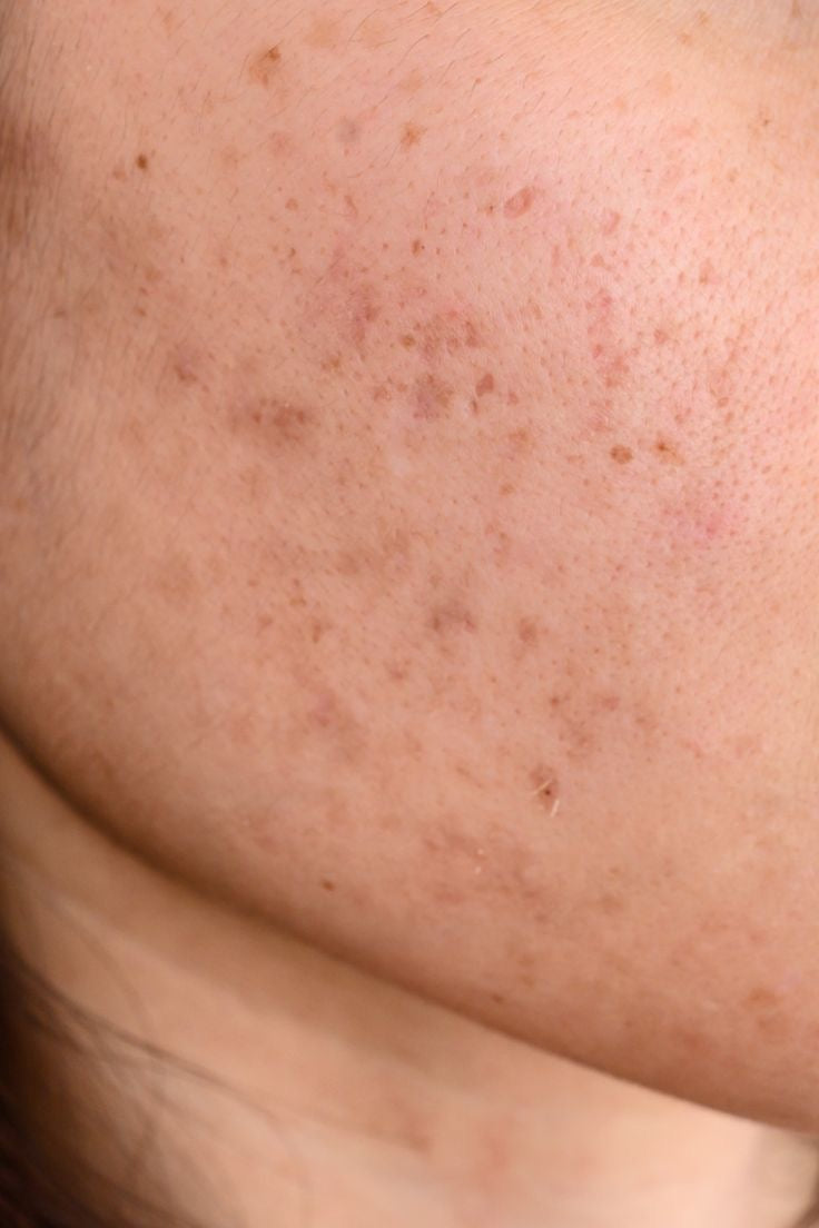 Acne Scars