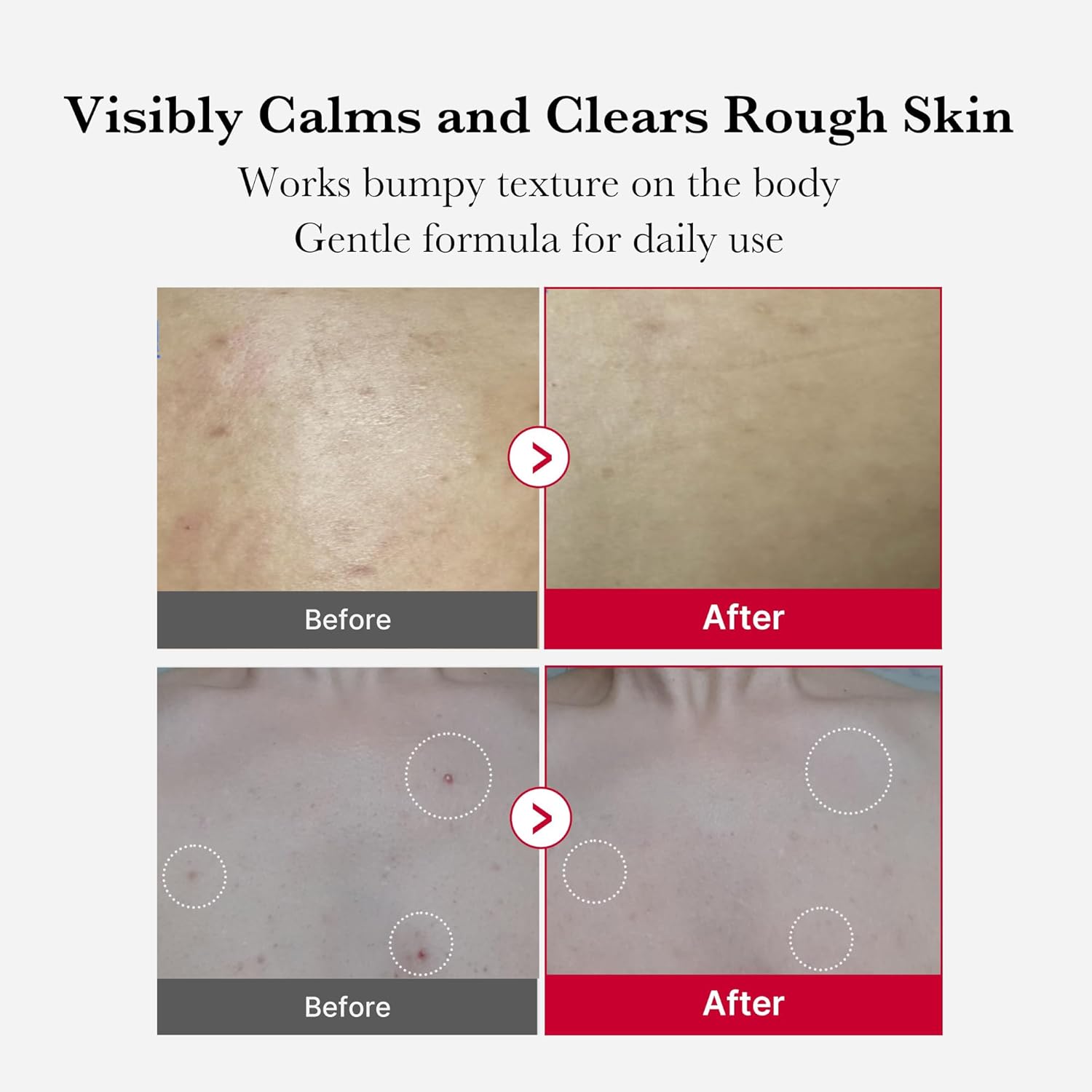 Medicube Red Acne Body Peeling Shot - 110 g